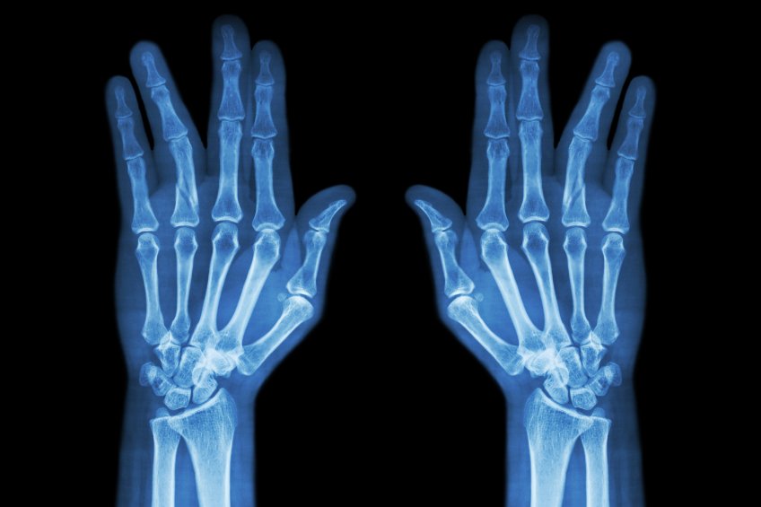 Delayed wrist fracture diagnosis