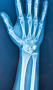 Distal Radius fracture misdiagnosis compensation claims