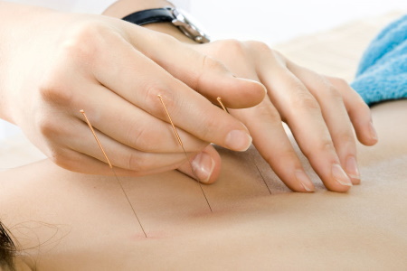 Dry needling gone wrong negligence compensation claims