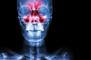 Misdiagnosed nasal fracture compensation claims