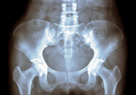 Missed acetabular fracture compensation claims