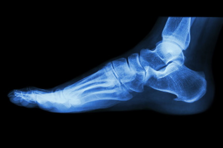 Missed ankle fracture compensation claims