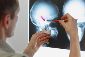 Missed cheekbone fracture compensation claims