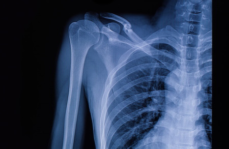 Missed clavicle fracture compensation claims