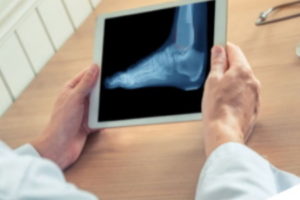 Missed cuboid fracture compensation claims