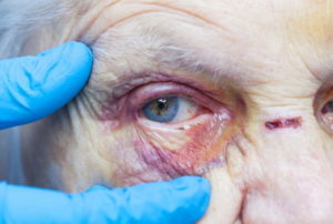 eye socket fracture misdiagnosis compensation