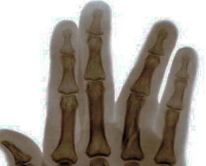 Missed fingertip fracture compensation claims