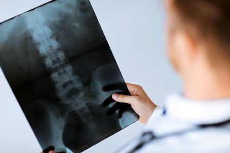 Missed fractured back compensation claims