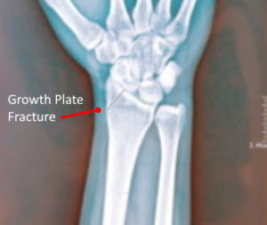 Missed growth plate fracture compensation claims