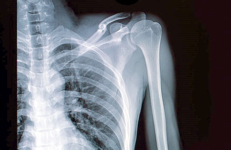 Missed head of humerus fracture compensation claims