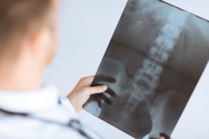 Missed hip fracture compensation claims