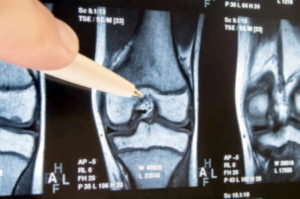 Missed knee fracture compensation claims