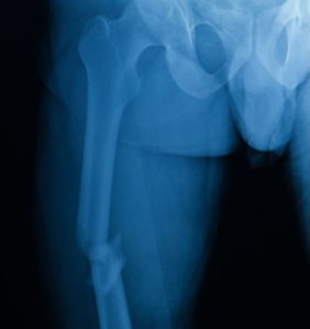 Missed leg fracture compensation claims