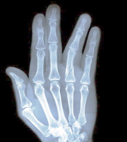 Missed metacarpal fracture compensation claims