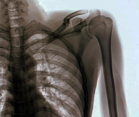 Missed neck of humerus fracture compensation claims
