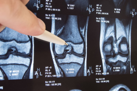 Missed patella fracture compensation claims