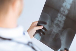 Missed pelvic fracture compensation claims