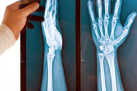 Missed scaphoid fracture compensation claims