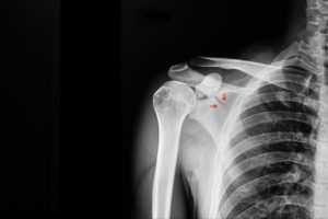 Missed scapula fracture compensation claims
