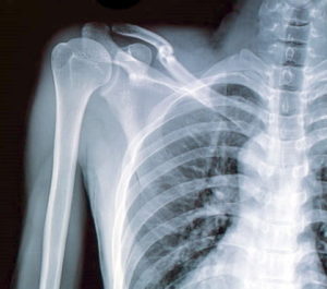 Missed shoulder fracture compensation claims