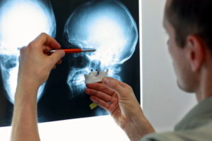 Missed skull fracture compensation claims