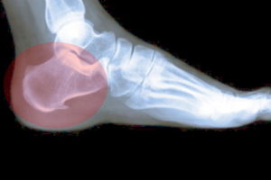 Missed talus fracture compensation claims