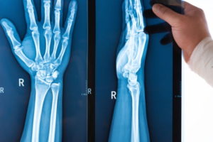 Missed wrist fracture compensation claims