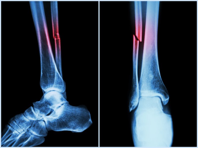 delayed ankle fracture diagnosis