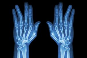 delayed finger fracture diagnosis 