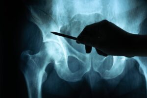 delayed hip fracture diagnosis