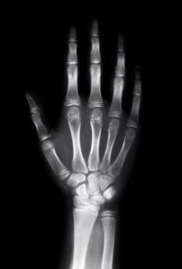 Delayed scaphoid fracture diagnosis