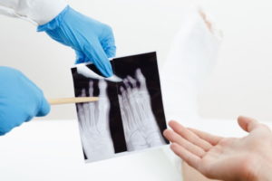 Missed foot fracture compensation claims
