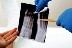 Missed toe fracture compensation claims